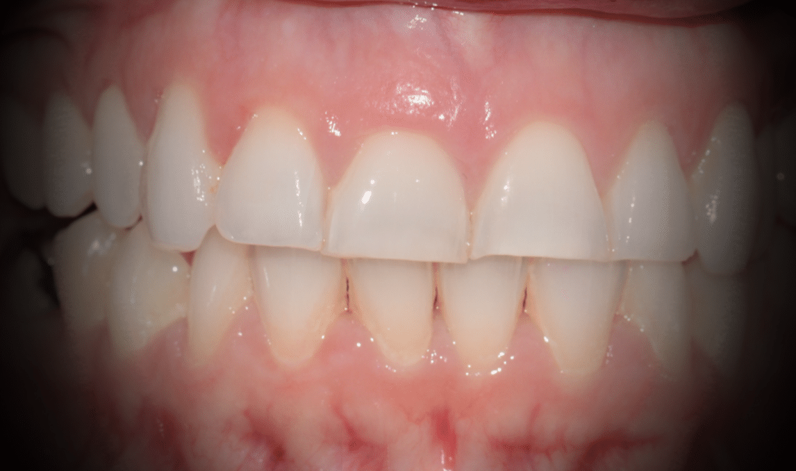 desgastes dentales