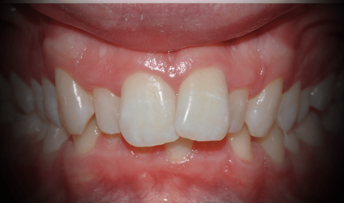 Tratamiento “Dientes salidos”