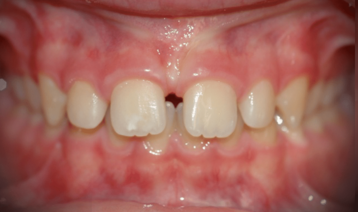 sonrisa gingival