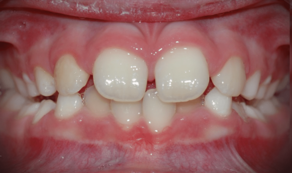 Mandíbula retraída e interposición labial