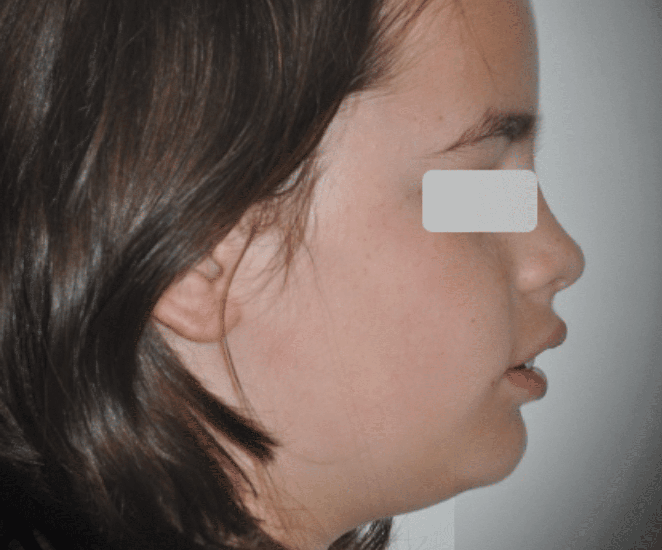 Mandíbula retraída e interposición labial