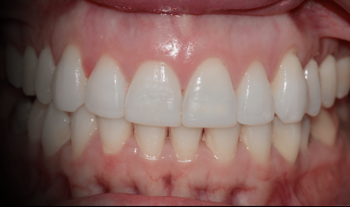 Tratamiento de desgastes dentales