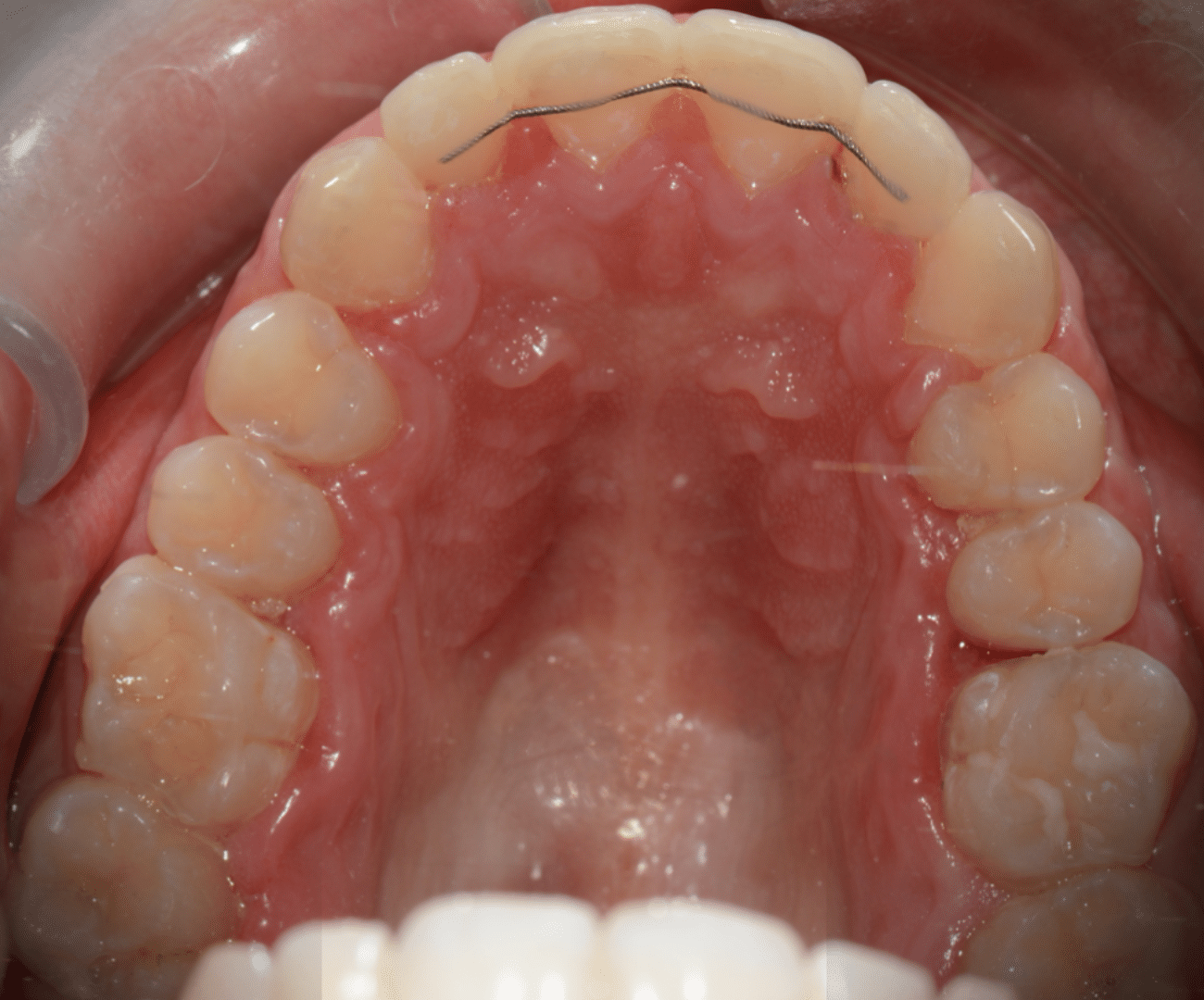 Tratamiento “Dientes salidos”