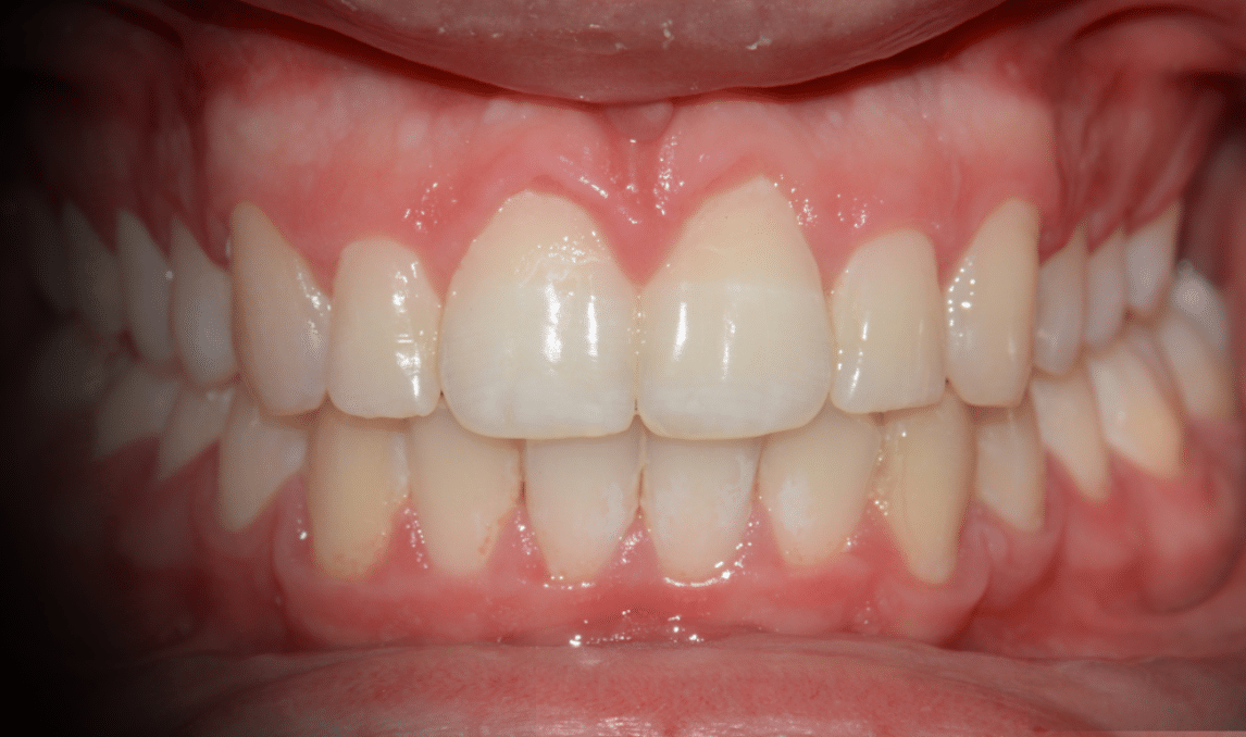 Tratamiento “Dientes salidos”