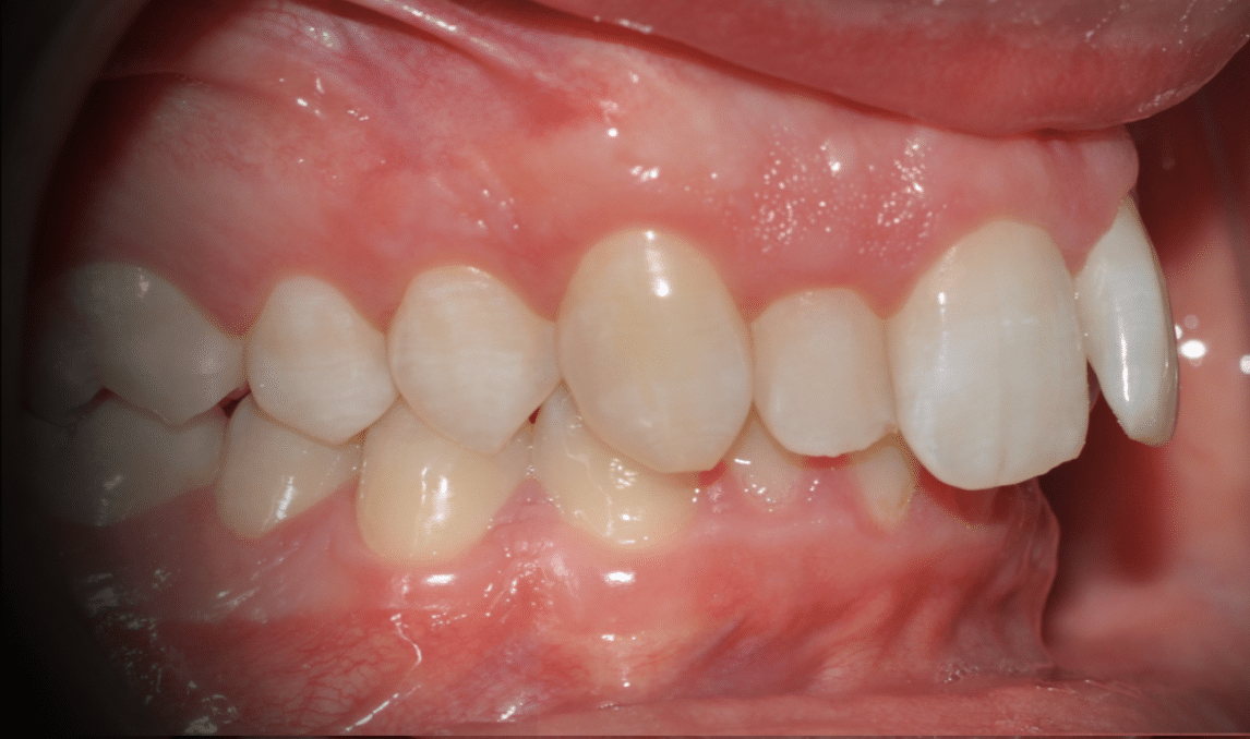 Tratamiento “Dientes salidos”