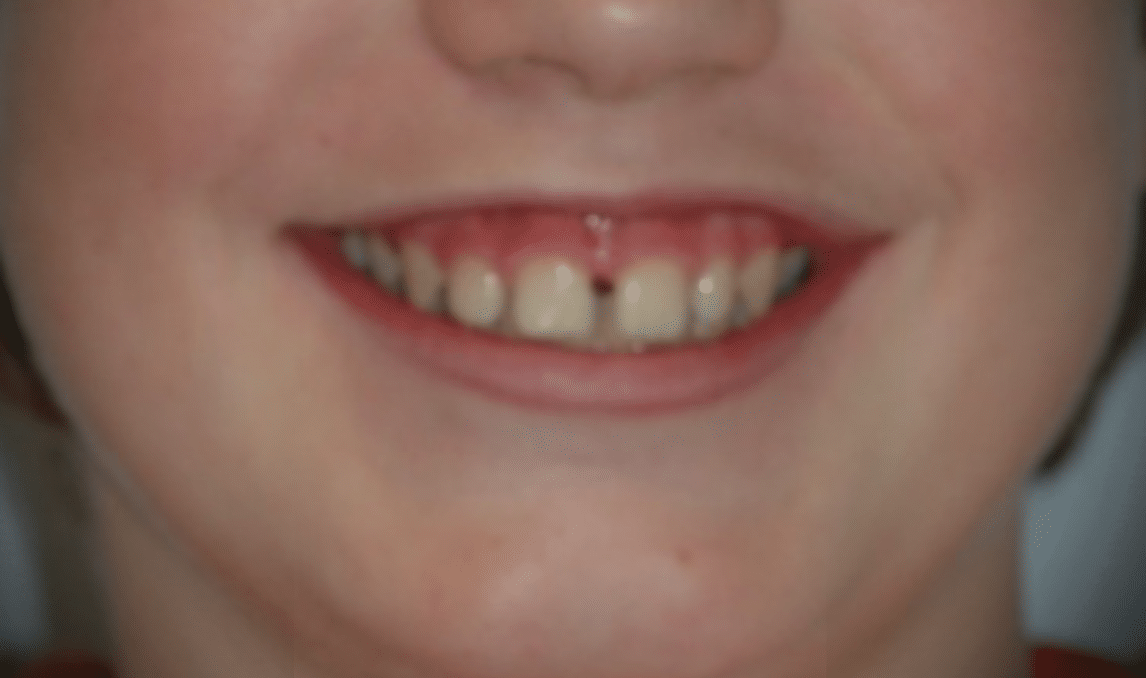 Diastema interincisivo y sonrisa gingival