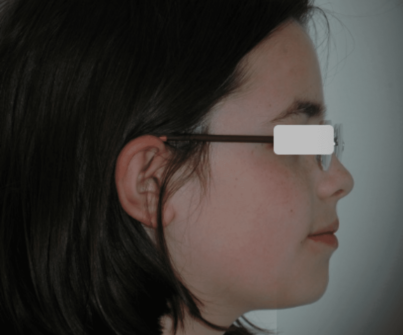 Mandíbula retraída e interposición labial