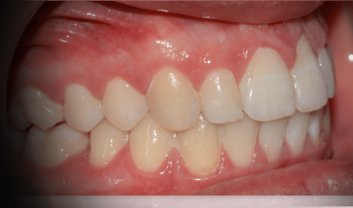 Tratamiento “Dientes salidos”