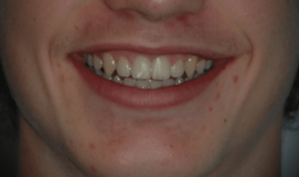 Diastema interincisivo y sonrisa gingival