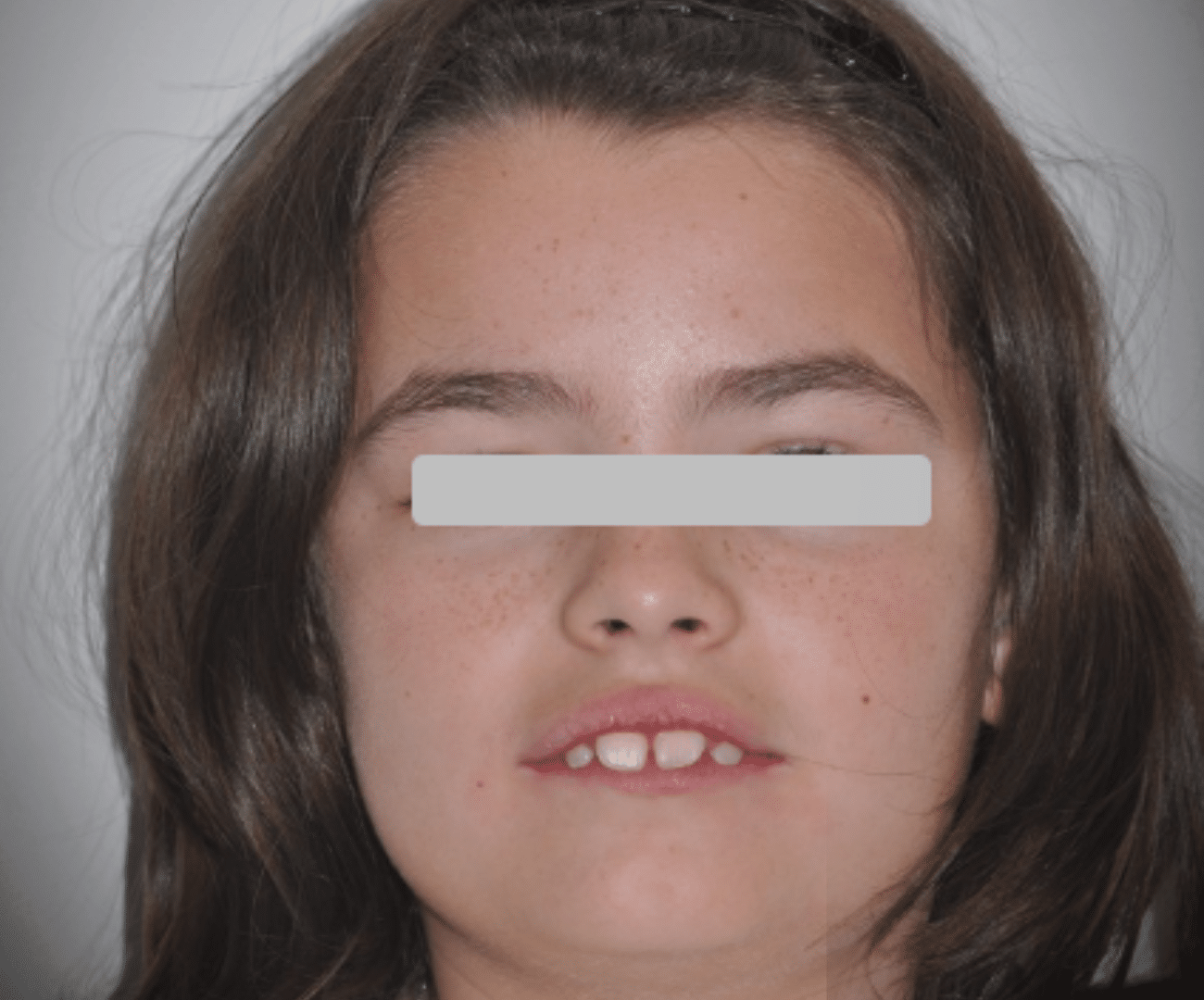 Mandíbula retraída e interposición labial