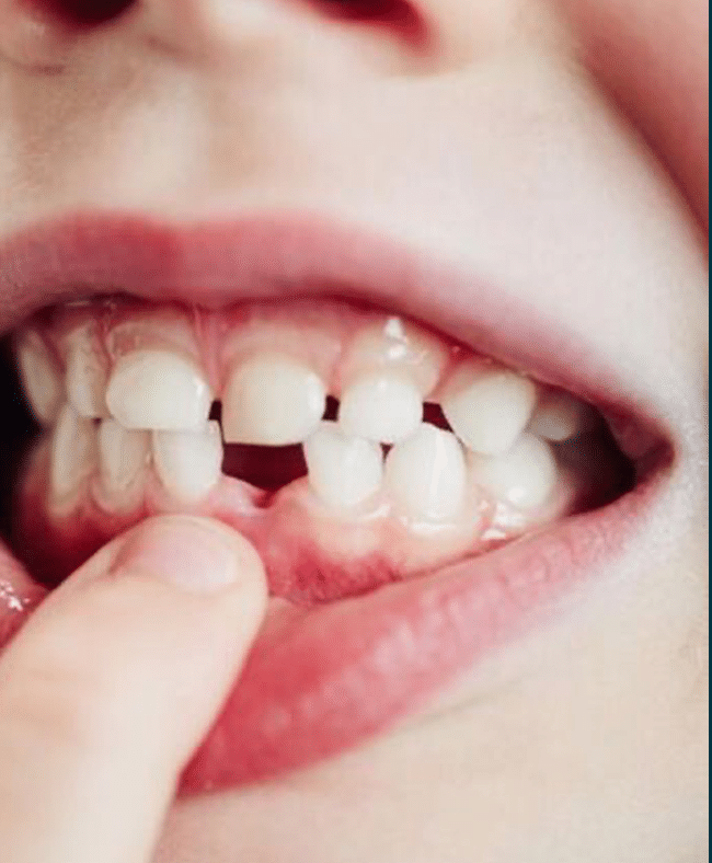 CUIDADO DE LOS DIENTES DE LECHE