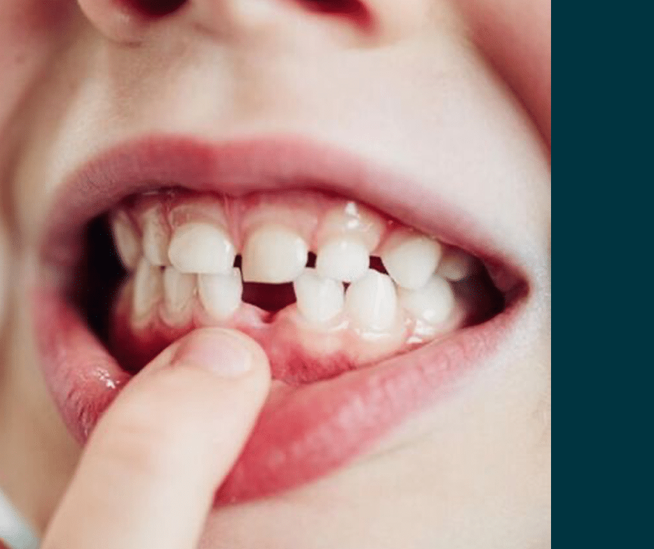 CUIDADO DE LOS DIENTES DE LECHE