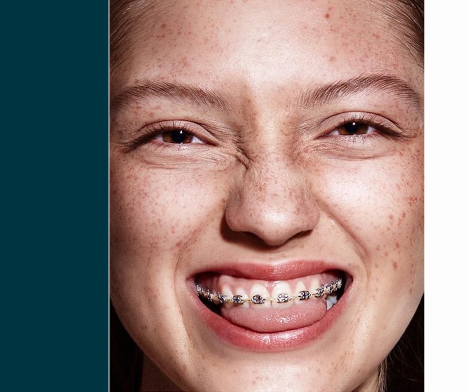 Brackets: Transformando Sonrisas